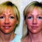 Rhinoplasty - Caucasian Before & After Patient #6247