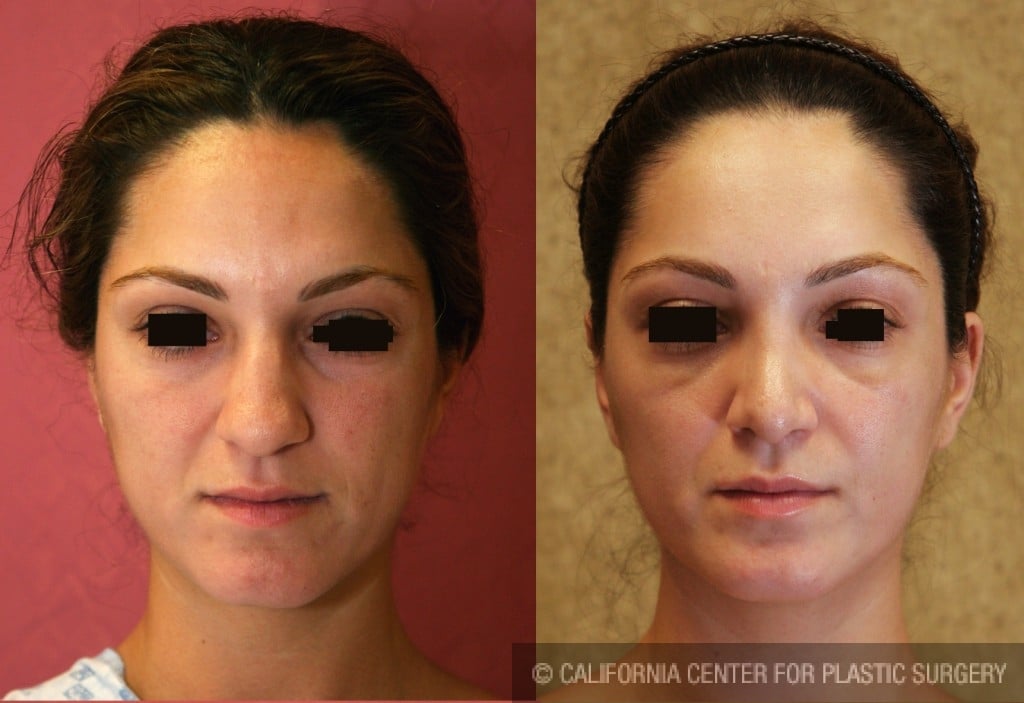 Rhinoplasty - Middle Eastern Before & After Patient #6347
