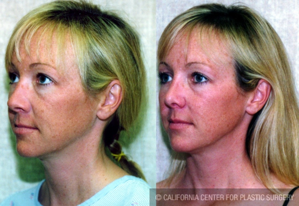 Rhinoplasty - Caucasian Before & After Patient #6247
