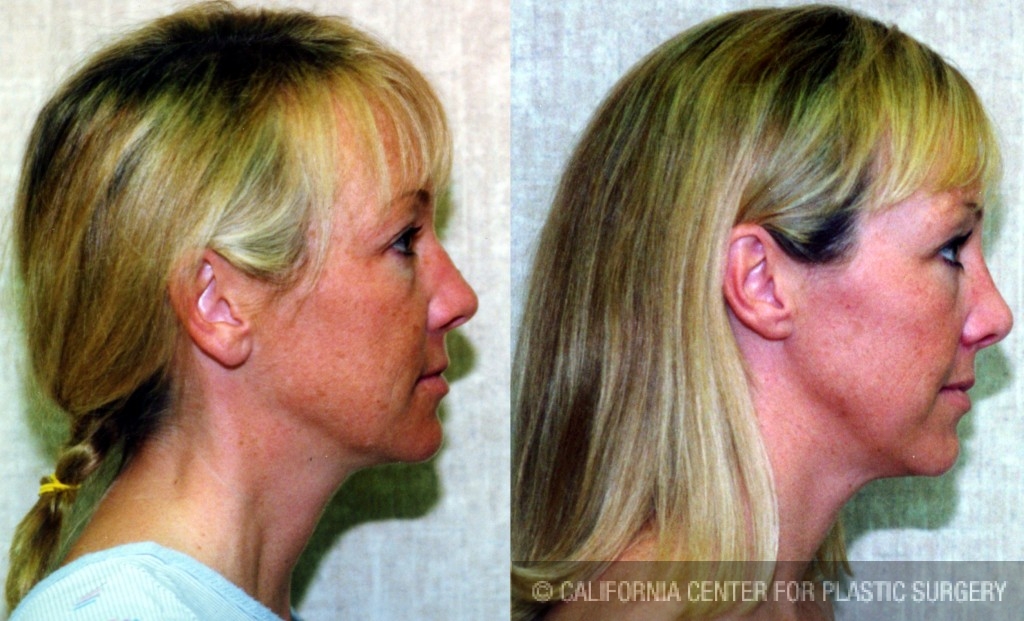 Rhinoplasty - Caucasian Before & After Patient #6247