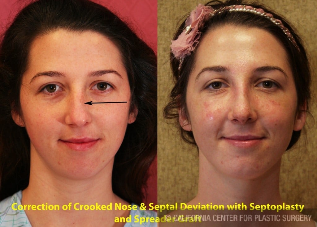 Rhinoplasty - Caucasian Before & After Patient #6201