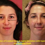 Rhinoplasty - Caucasian Before & After Patient #6201