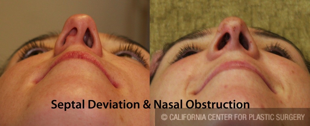 Rhinoplasty - Caucasian Before & After Patient #6201