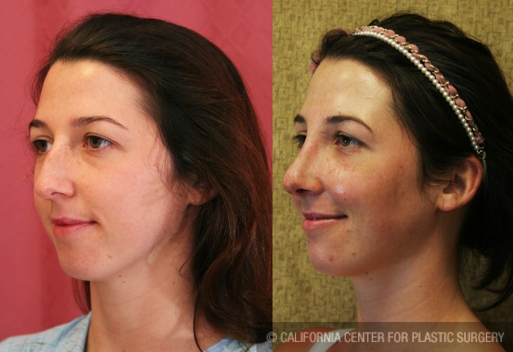 Rhinoplasty - Caucasian Before & After Patient #6201