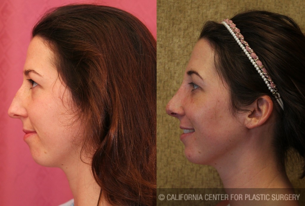 Rhinoplasty - Caucasian Before & After Patient #6201