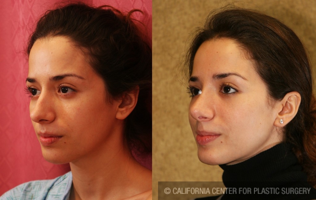 Rhinoplasty - Caucasian Before & After Patient #6196