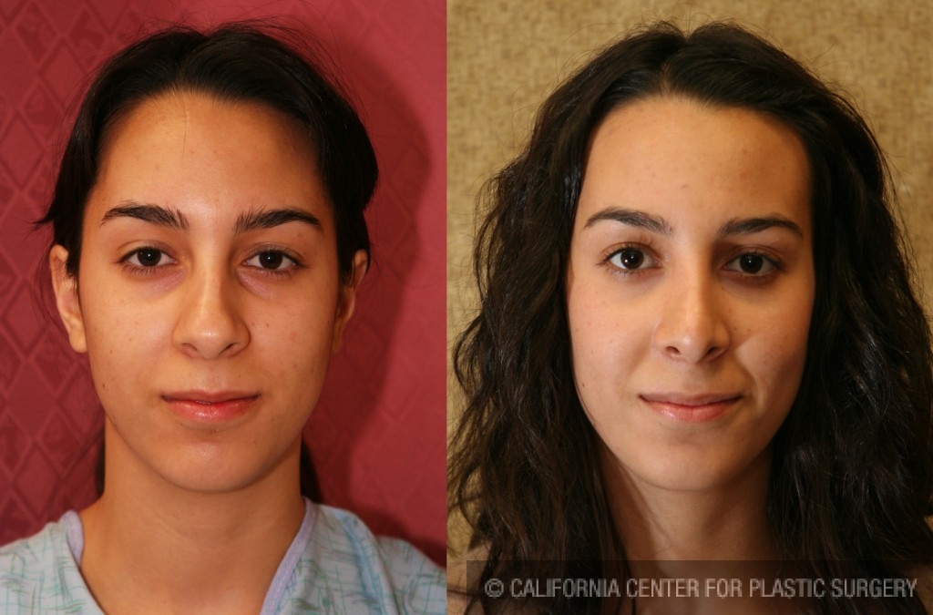 Rhinoplasty - Caucasian Before & After Patient #6224