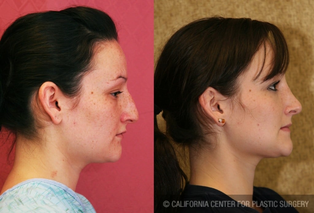 Rhinoplasty - Caucasian Before & After Patient #6214
