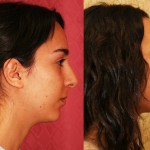 Rhinoplasty - Caucasian Before & After Patient #6224