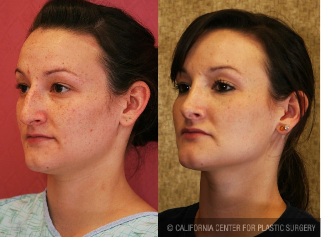 Rhinoplasty - Caucasian Before & After Patient #6214