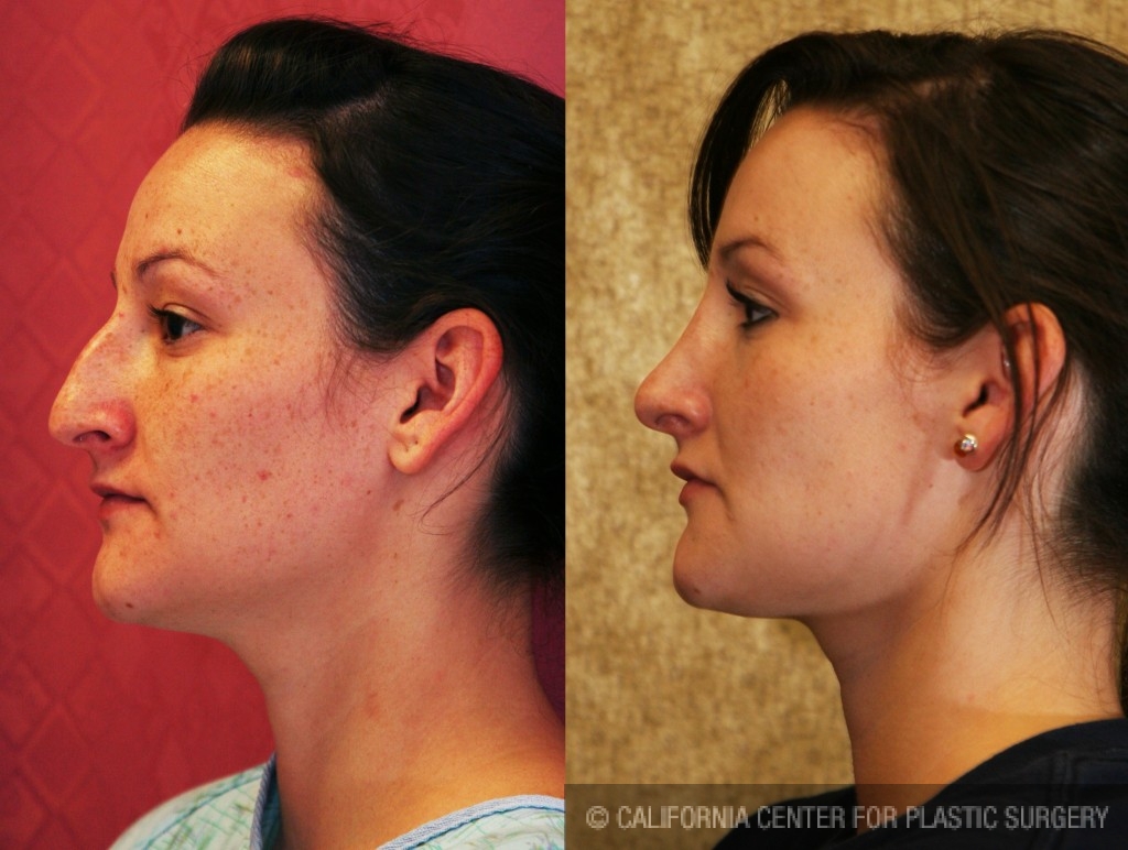 Rhinoplasty - Caucasian Before & After Patient #6214