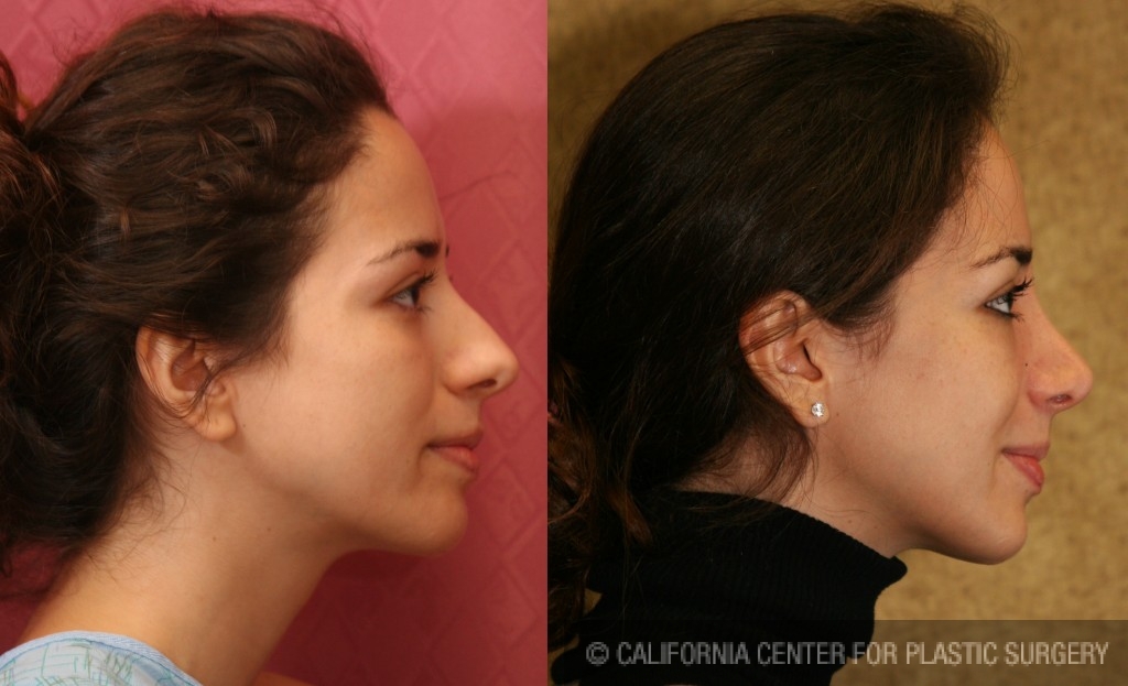 Rhinoplasty - Caucasian Before & After Patient #6196