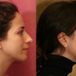 Rhinoplasty - Caucasian Before & After Patient #6196