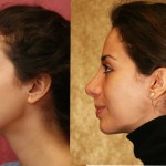 Rhinoplasty - Caucasian Before & After Patient #6196