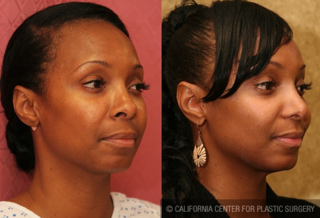 Rhinoplasty - African American Before & After Patient #6309