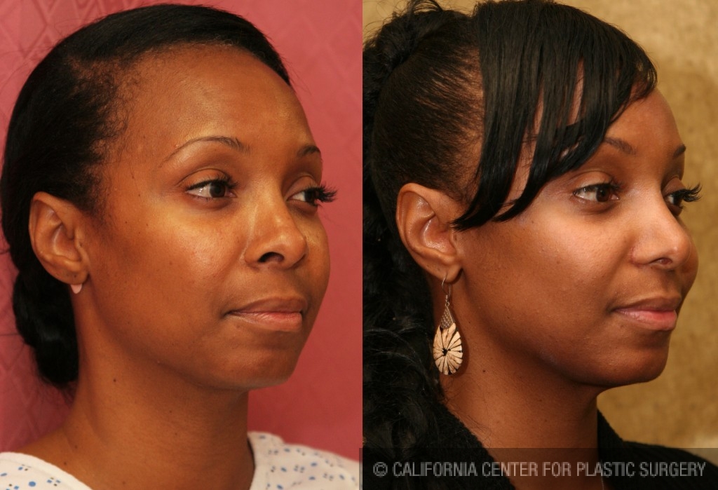 Rhinoplasty - African American Before & After Patient #6309