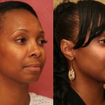 Rhinoplasty - African American Before & After Patient #6309