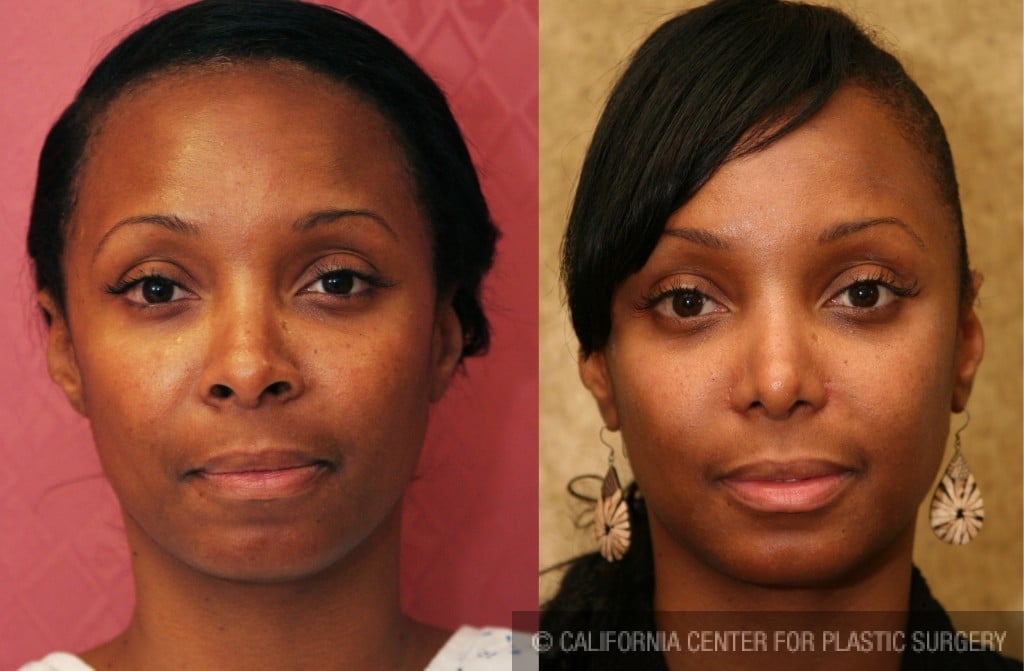 Rhinoplasty - African American Before & After Patient #6309