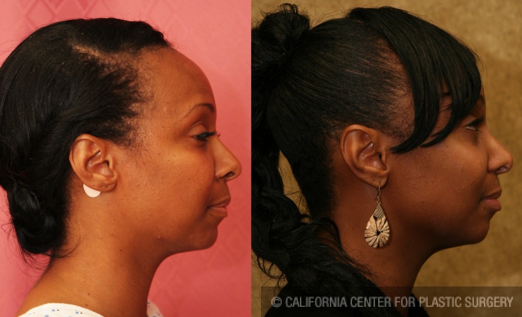 Rhinoplasty - African American Before & After Patient #6309