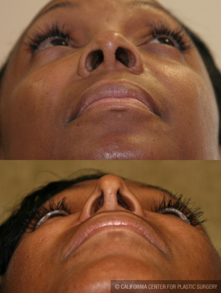 Rhinoplasty - African American Before & After Patient #6309