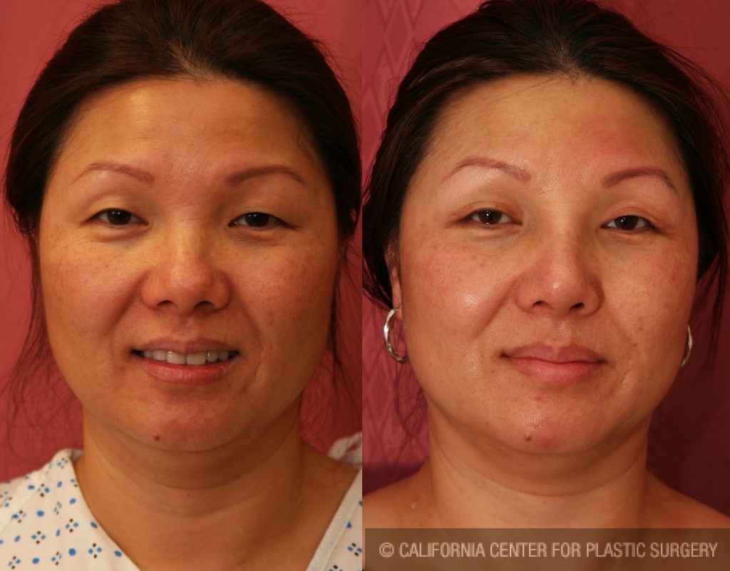 Rhinoplasty - Asian Before & After Patient #6375