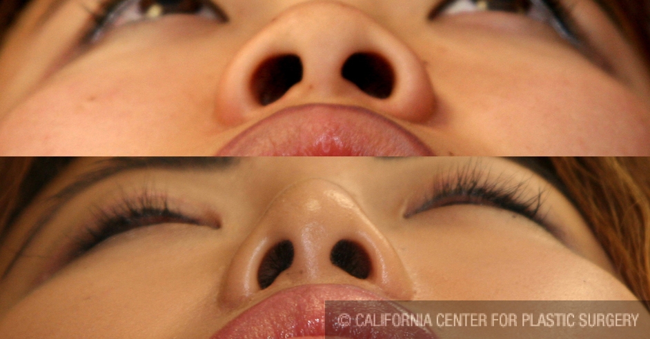 Rhinoplasty - Asian Before & After Patient #6375