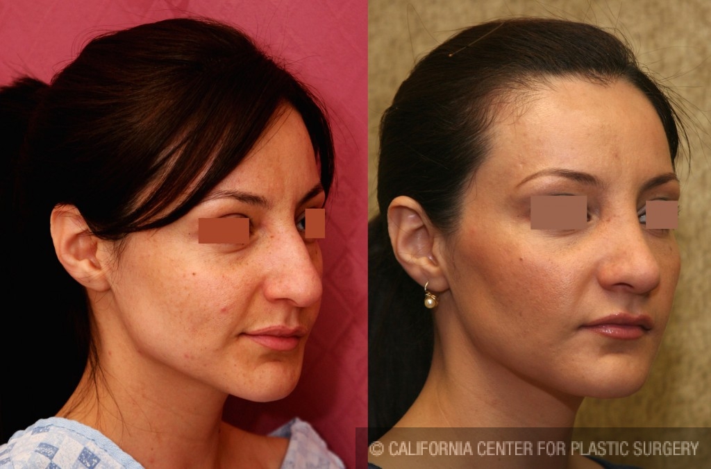 Rhinoplasty - Hispanic Before & After Patient #6255