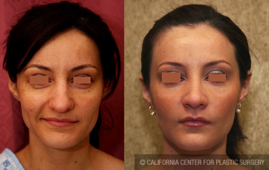 Rhinoplasty - Hispanic Before & After Patient #6255