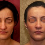 Rhinoplasty - Hispanic Before & After Patient #6255