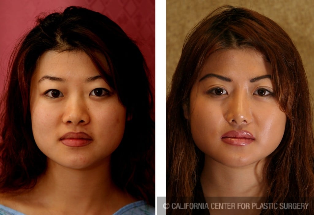 Rhinoplasty - Asian Before & After Patient #6394