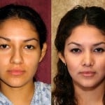 Rhinoplasty - Hispanic Before & After Patient #6292