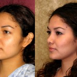 Rhinoplasty - Hispanic Before & After Patient #6292