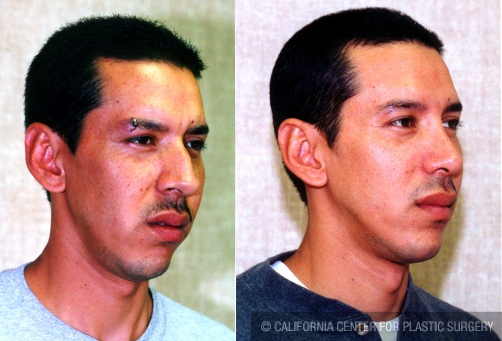 Male Rhinoplasty Before & After Patient #6401