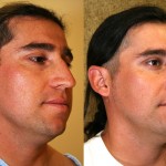 Male Rhinoplasty Before & After Patient #6405