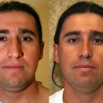 Male Rhinoplasty Before & After Patient #6405