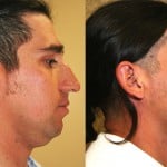 Male Rhinoplasty Before & After Patient #6405