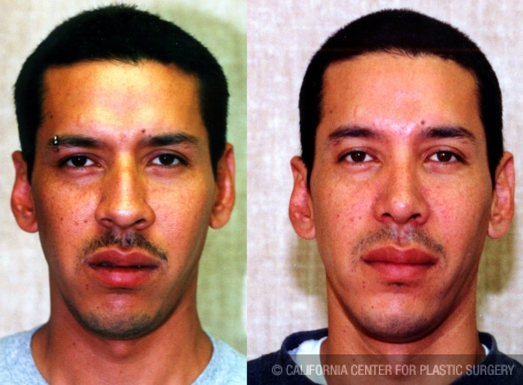 Male Rhinoplasty Before & After Patient #6401