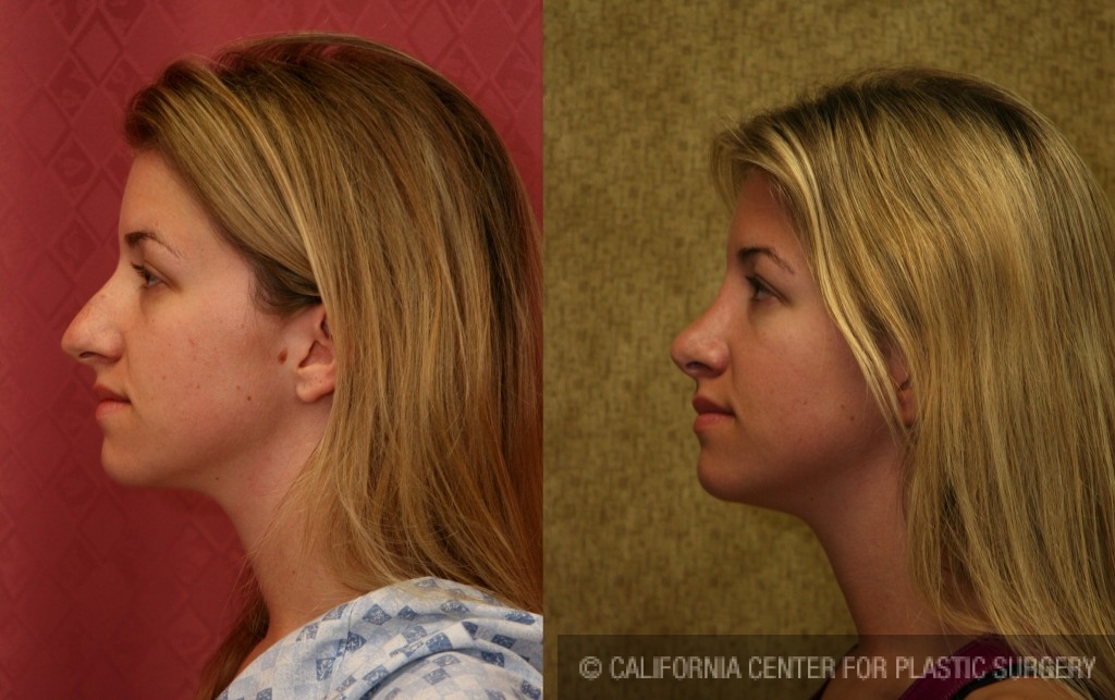 Rhinoplasty - Caucasian Before & After Patient #6190