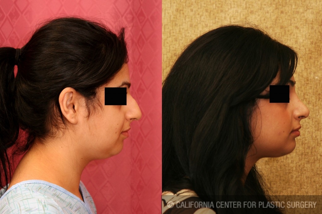 Rhinoplasty - Middle Eastern Before & After Patient #6334