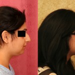 Rhinoplasty - Middle Eastern Before & After Patient #6334