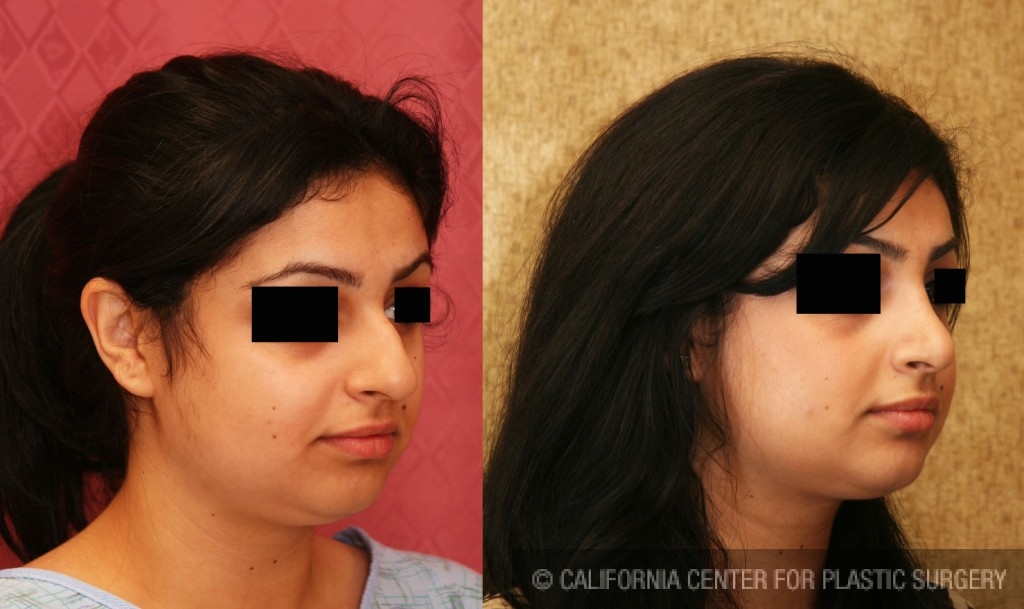 Rhinoplasty - Middle Eastern Before & After Patient #6334