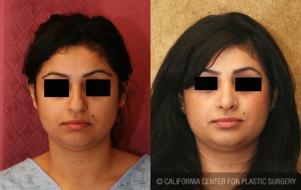 Rhinoplasty - Middle Eastern Before & After Patient #6334