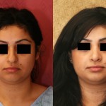 Rhinoplasty - Middle Eastern Before & After Patient #6334