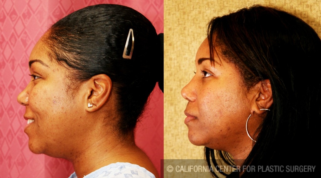 Rhinoplasty - African American Before & After Patient #6300