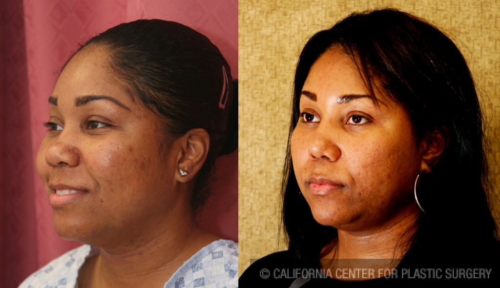 Rhinoplasty - African American Before & After Patient #6300
