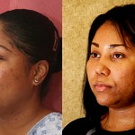 Rhinoplasty - African American Before & After Patient #6300