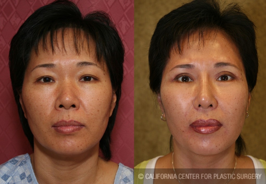 Rhinoplasty - Asian Before & After Patient #6368