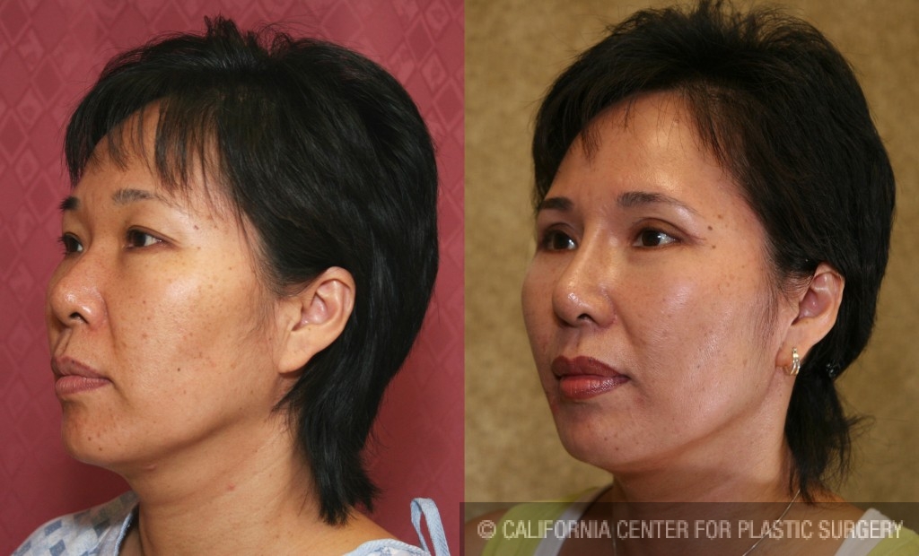 Rhinoplasty - Asian Before & After Patient #6368