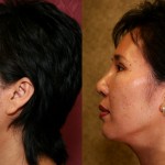 Rhinoplasty - Asian Before & After Patient #6368