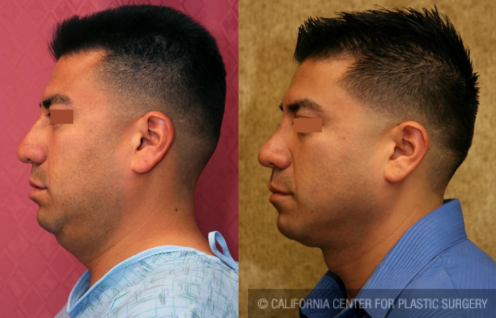 Male Rhinoplasty Before & After Patient #6418